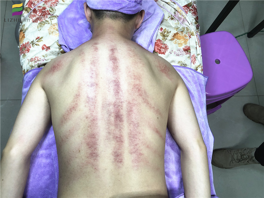 南寧美容學校：美容直播搶先看---背部刮痧