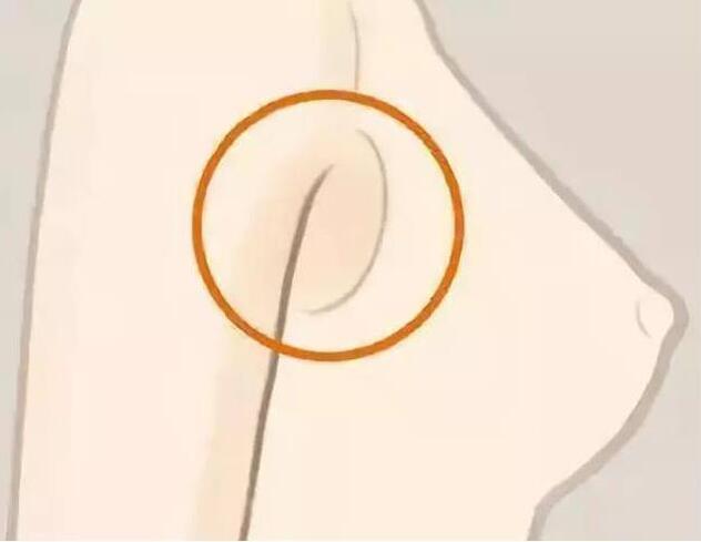 減副乳，瘦手臂一招就解決！