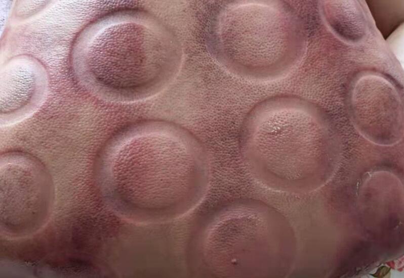 拔火罐有什么用？廣西美容職業(yè)培訓學校演示給你看